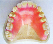 ノンクラスプギシ